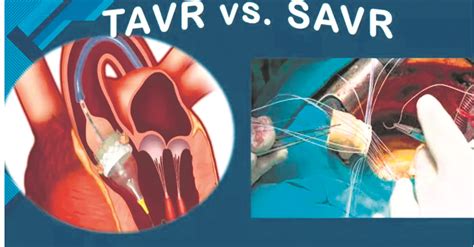 saavr